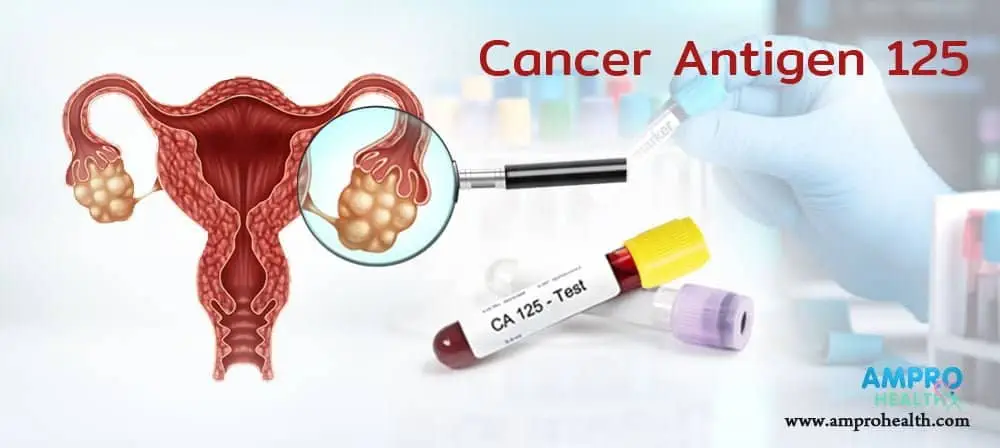 CA 125 สารวัดค่ามะเร็งรังไข่ CA 125 สารวัดค่ามะเร็งรังไข่