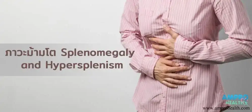 อาการม้ามโตบ่งบอกอะไร ( Splenomegaly) อาการม้ามโตบ่งบอกอะไร ( Splenomegaly)