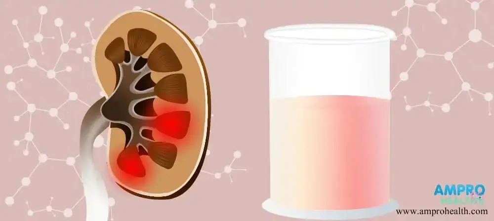 อาการปัสสาวะเป็นเลือด ( Hematuria ) อาการปัสสาวะเป็นเลือด ( Hematuria )