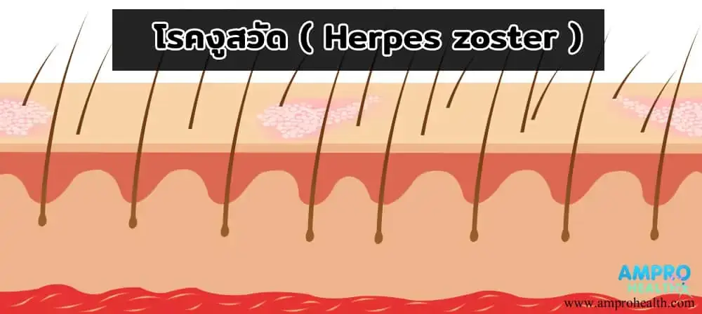 โรคงูสวัด ( Herpes Zoster ) โรคงูสวัด ( Herpes Zoster )