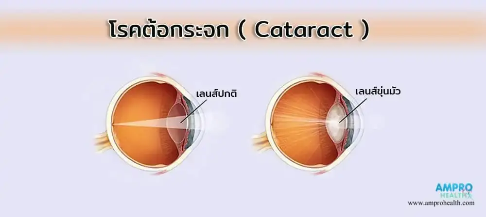 โรคต้อกระจก ( Cataract ) โรคต้อกระจก ( Cataract )