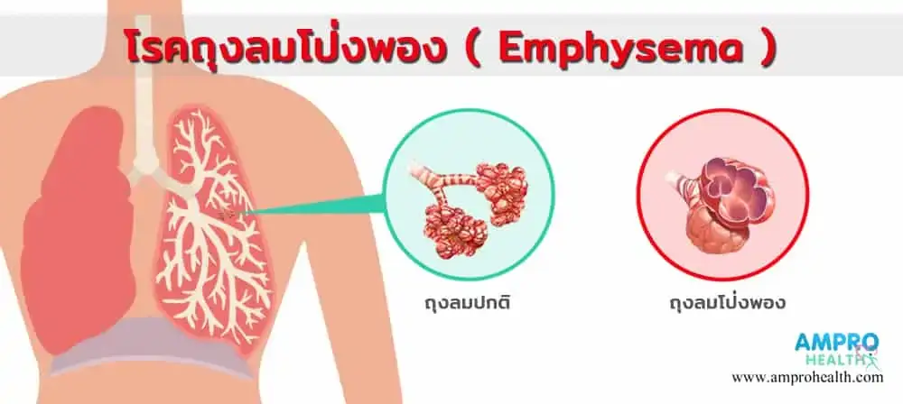 โรคถุงลมโป่งพอง ( Emphysema ) โรคถุงลมโป่งพอง ( Emphysema )