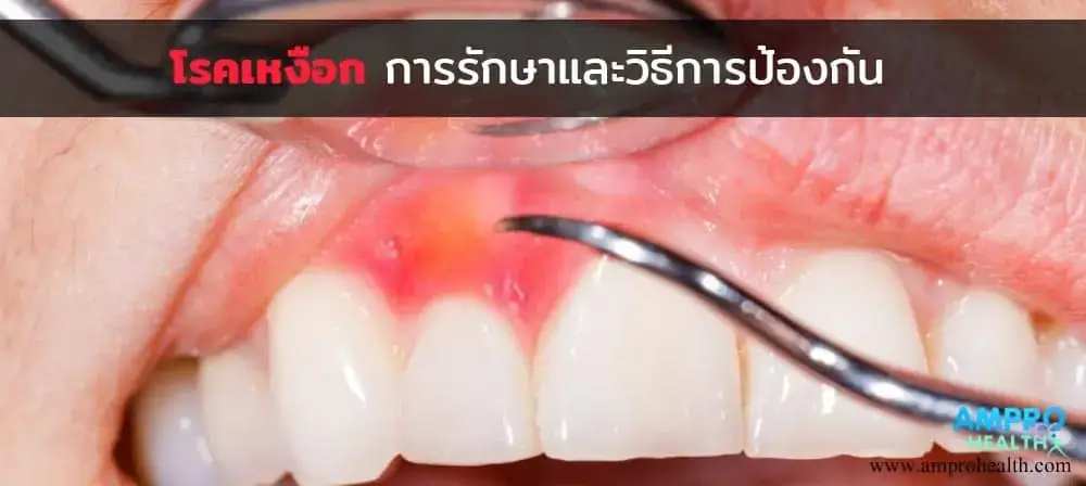 โรคเหงือก การรักษาและวิธีการป้องกัน โรคเหงือก การรักษาและวิธีการป้องกัน