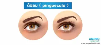 โรคต้อลม ( Pinguecula ) โรคต้อลม ( Pinguecula )