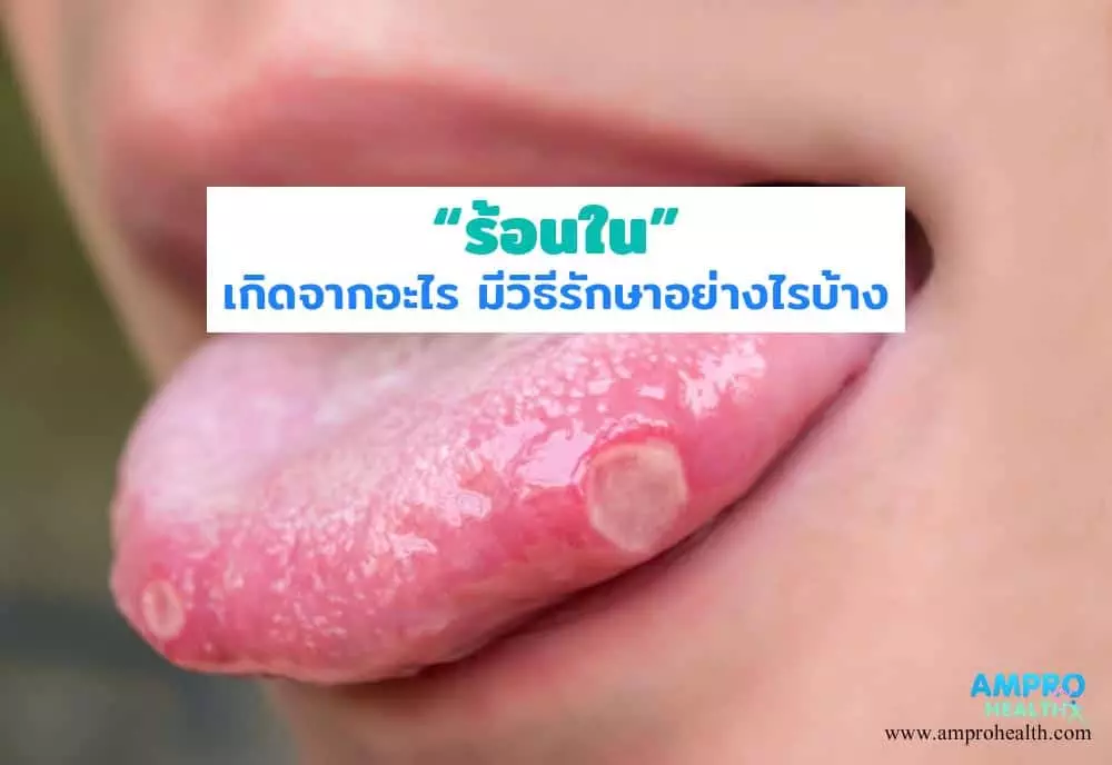 ร้อนในเกิดจากอะไร มีวิธีรักษาอย่างไรบ้าง - Am Pro Health